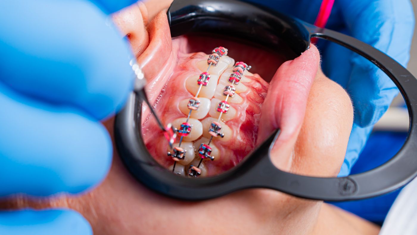 ORTHO — Ортодонтія та брекети